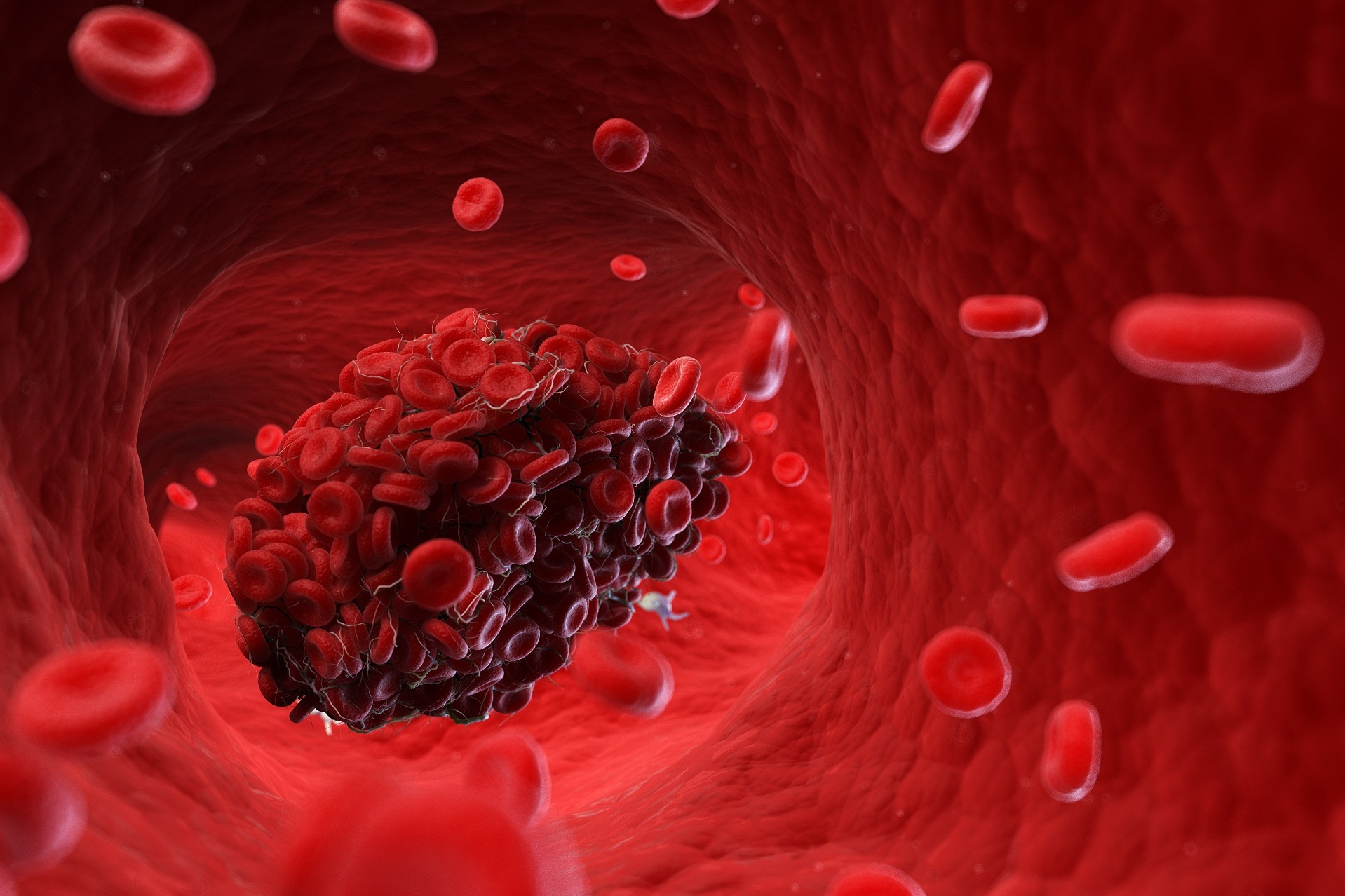 Deficiência da proteína C trombose venosa profunda TVP